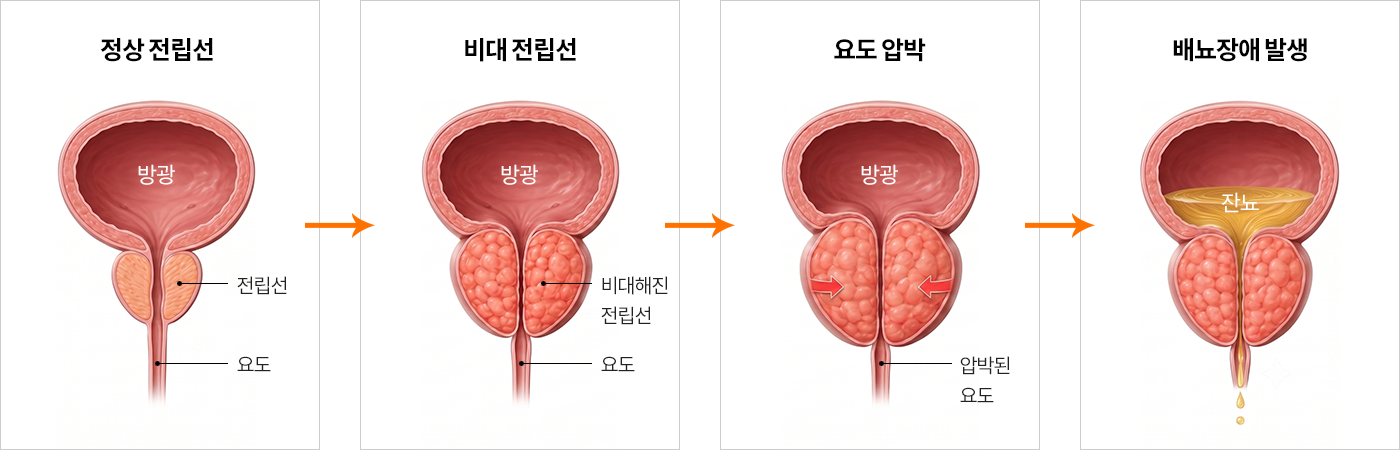 남성의 전립선이 방광 아래 위치하여 요도를 감싸고 있는 해부학적 구조를 설명한 이미지